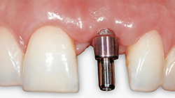 PROPHYflex4_Subgingival-implantat_700.jpg